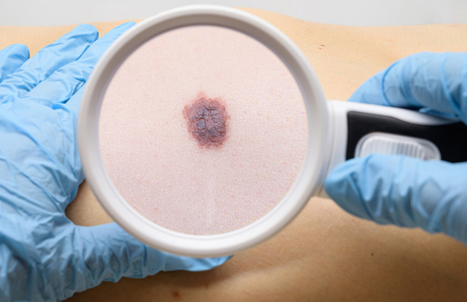 Mapa corporal de nevus