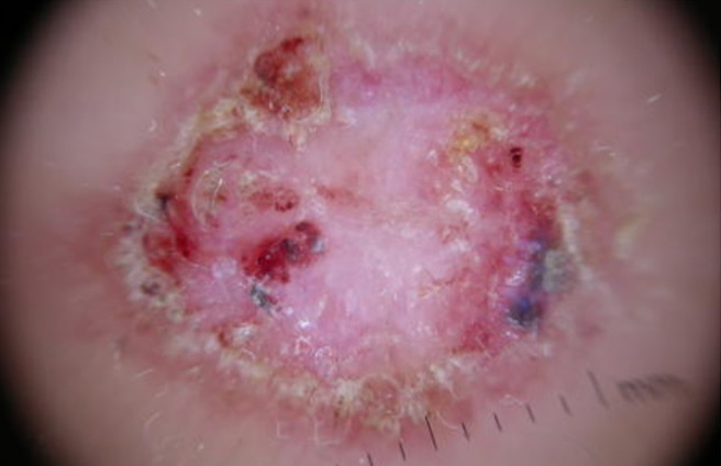 Diagnòstic precoç del càncer de pell